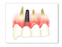 インプラント